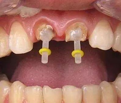 牙根打桩在线视频,在线视频教学全解析  第1张