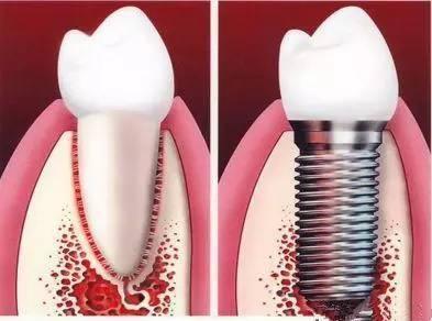 牙根打桩在线视频,在线视频教学全解析  第2张